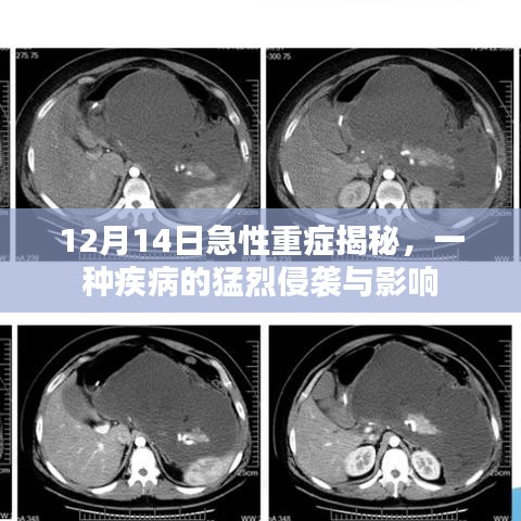 12月14日急性重症揭秘,疾病猛烈侵袭及其影响