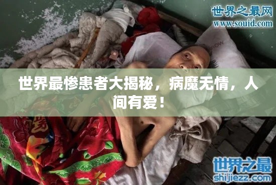 世界最惨患者大揭秘,病魔无情,人间有爱!